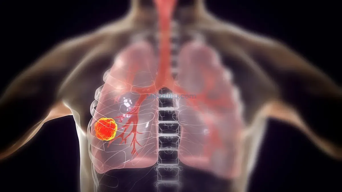 BioNTech’ten Akciğer Kanserinde Dikkat Çeken Sonuç: Yaşam Süresi Neredeyse İkiye Katlandı